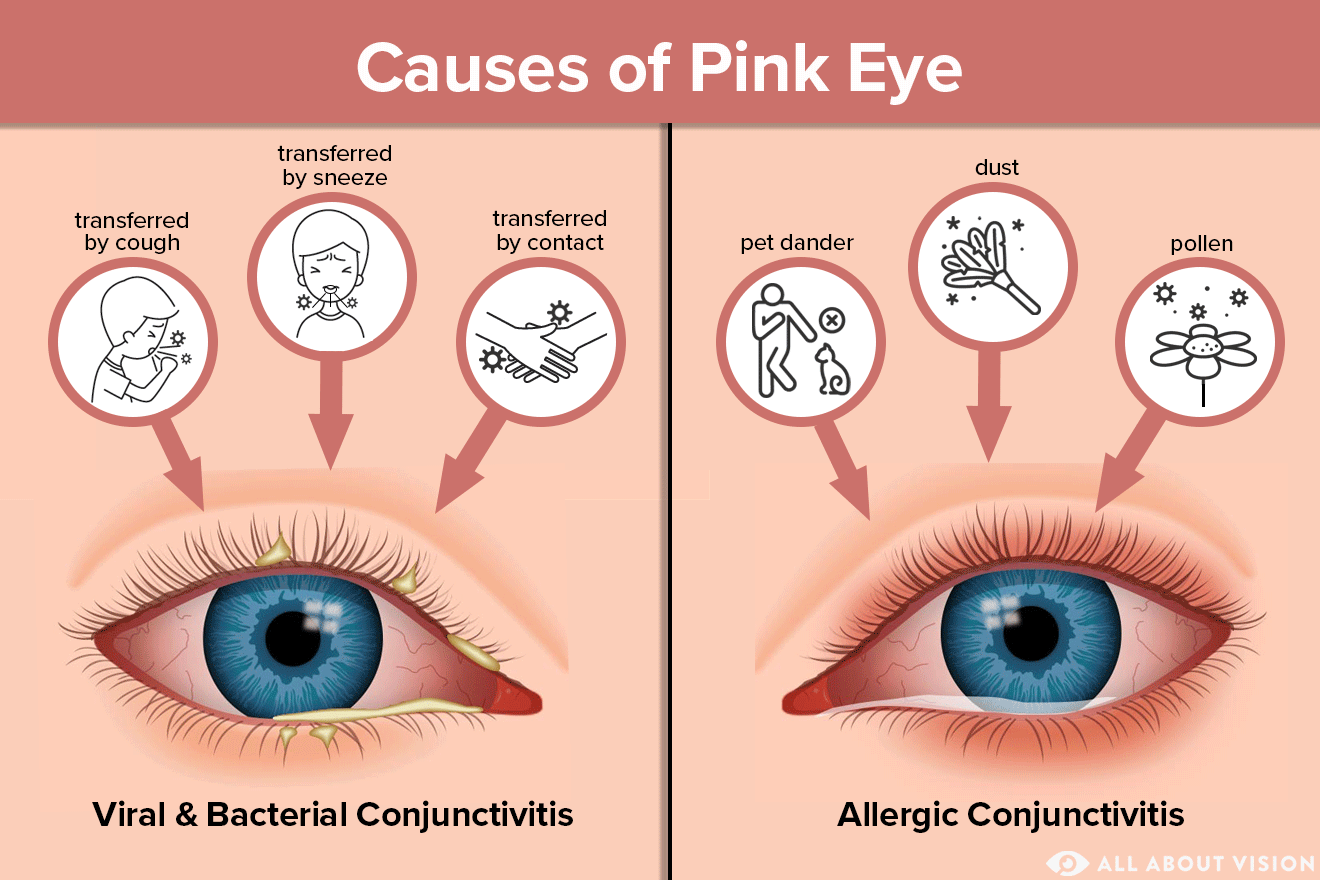 graphic image explaining Causes of Pink Eye Black