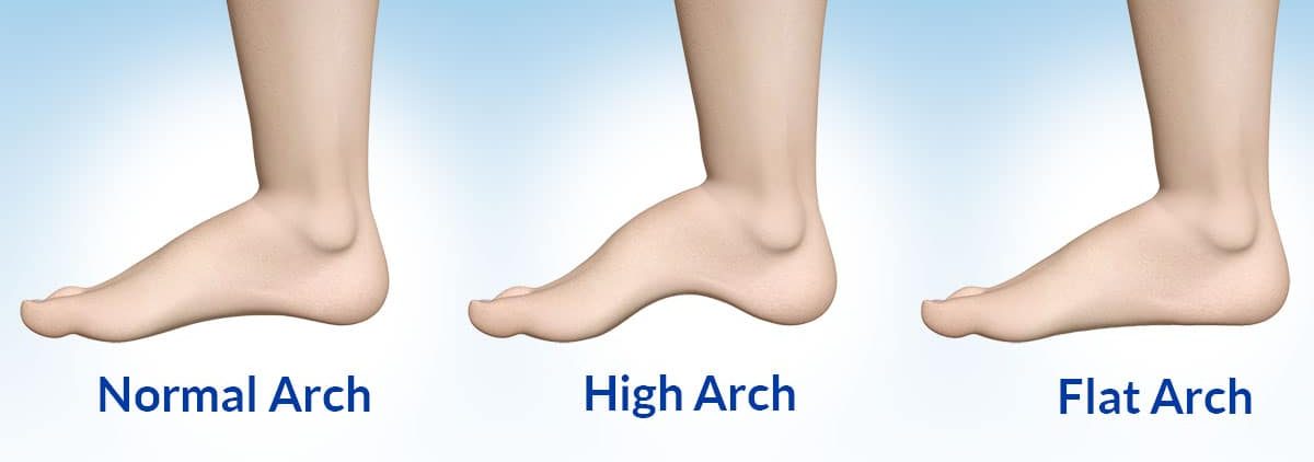 arch types of ancles to check Is heel pain a sign of cancer