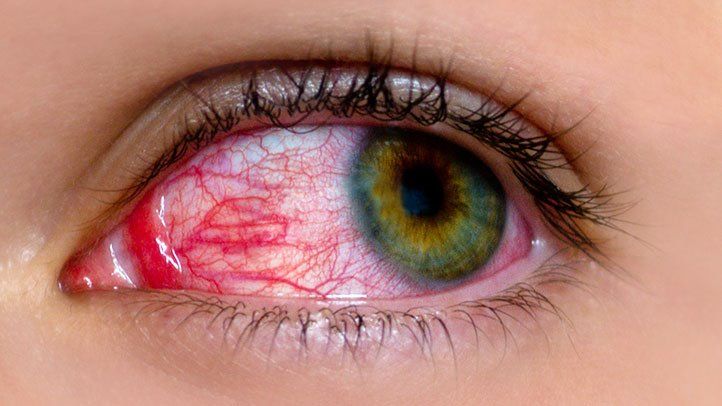 green eye but with infections